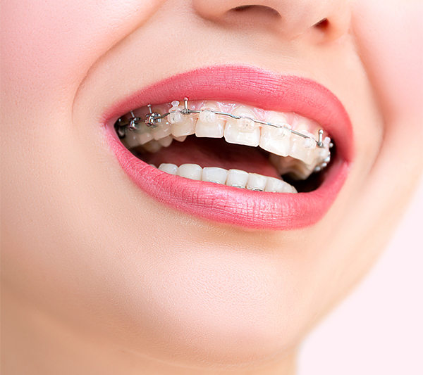 Ortodonti Nedir? Ne ile İlgilenir?