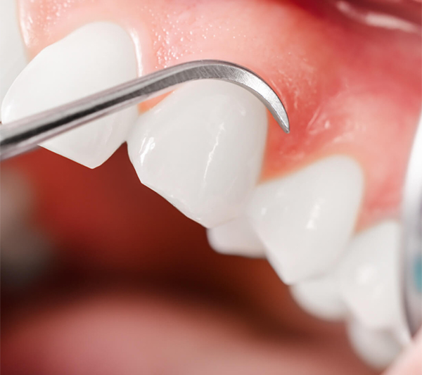 Periodontoloji (Diş eti) Tedavisi Nasıl Yapılır?
