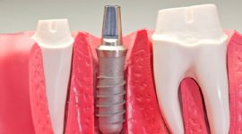 Dental (Diş) İmplant Tedavileri